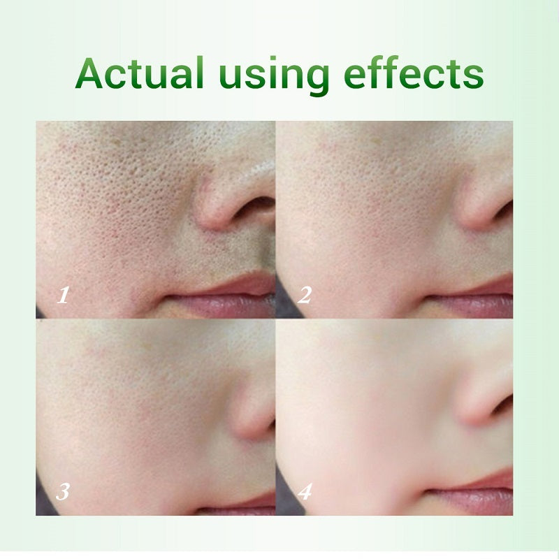 Salicylic Acid Pore Refinement Cream Lotion Skin Rejuvenation Cream Skin Care Products Salicylic Acid Pore Refinement Cream Lotion Skin Rejuvenation Cream Skin Care Products